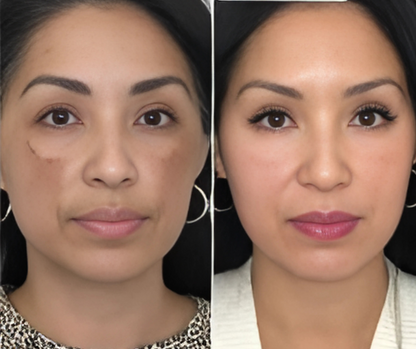 Hydroquinone Cream USP 4% – Skin Lightening & Dark Spot Treatment for Melasma, Hyperpigmentation & Uneven Skin Tone