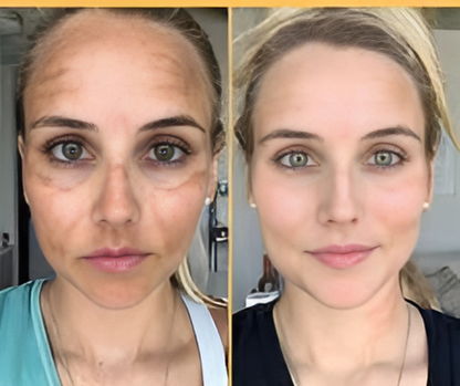 Hydroquinone Cream USP 4% – Skin Lightening & Dark Spot Treatment for Melasma, Hyperpigmentation & Uneven Skin Tone